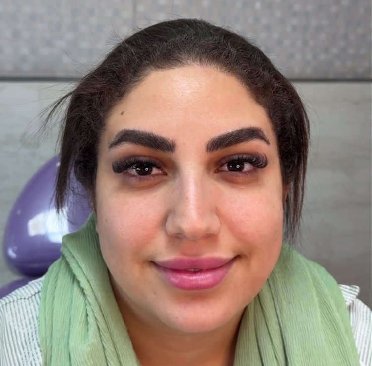 بعد — قبل بعد بوتاکس