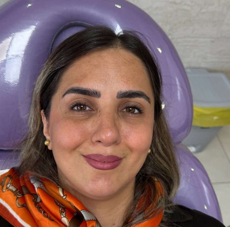 بعد — قبل و بعد بوتاکس