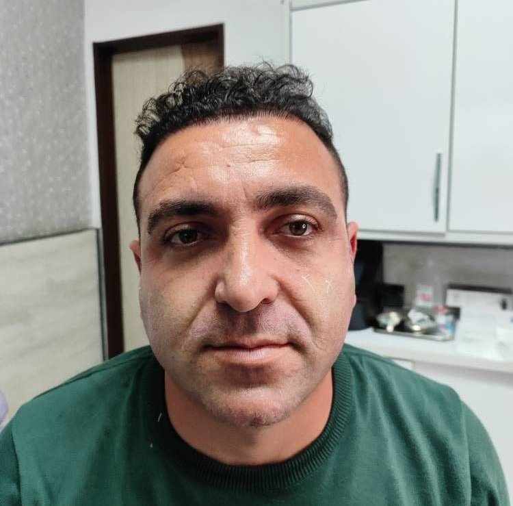 قبل — قبل و بعد فیلر شقیقه