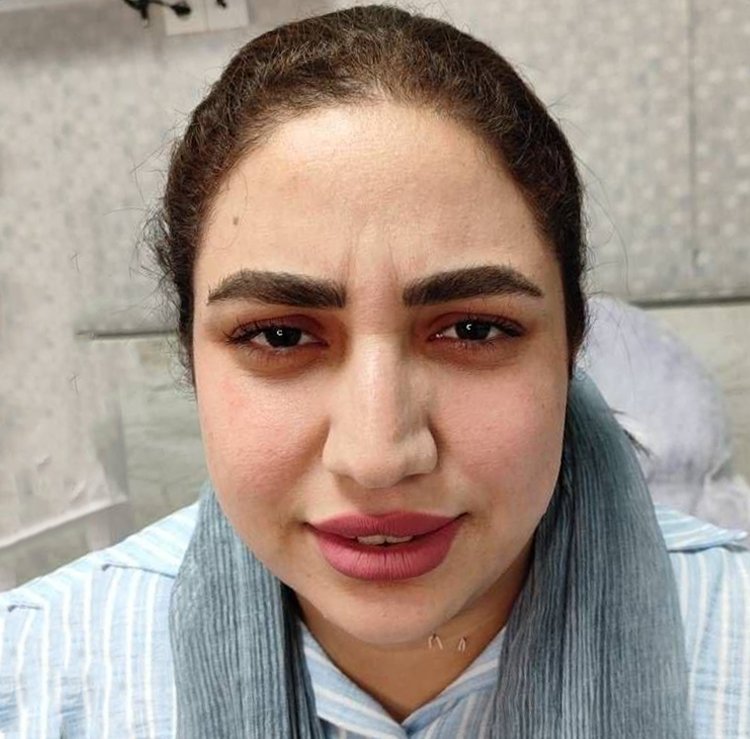 قبل — قبل بعد بوتاکس