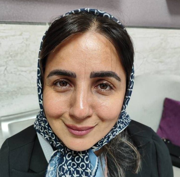 قبل — قبل و بعد بوتاکس