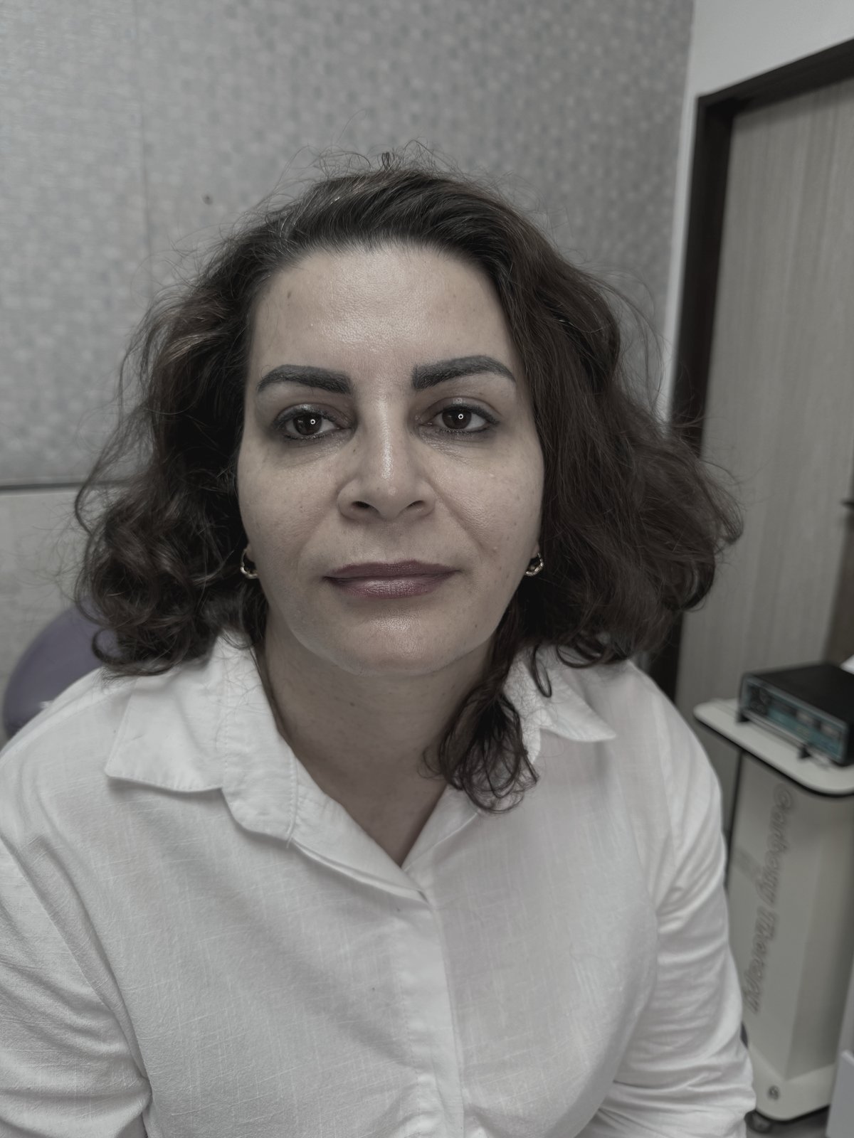 قبل — بوتاکس — شادابی و جوانسازی چهره
